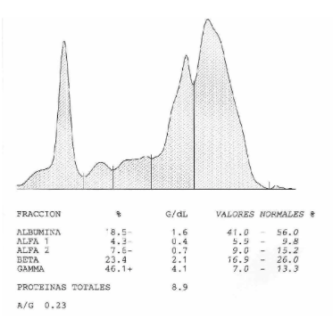Proteínograma de un perro con ehrlichiosis, el incremento de las fracciones beta y gamma es evidente
