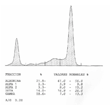 Proteínograma de un perro con leishmaniosis, con un pico monoclonal en gamma