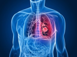 Test del sudor para diagnosticar Fibrosis Quística
